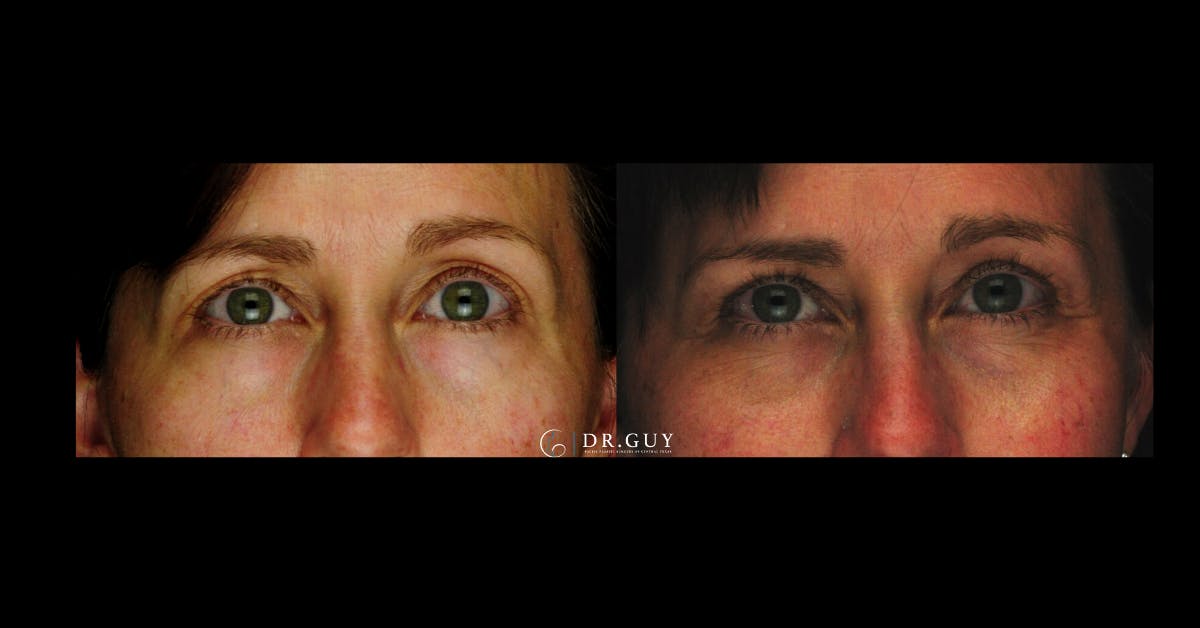 Lower Blepharoplasty Before & After Gallery - Patient 201537 - Image 3
