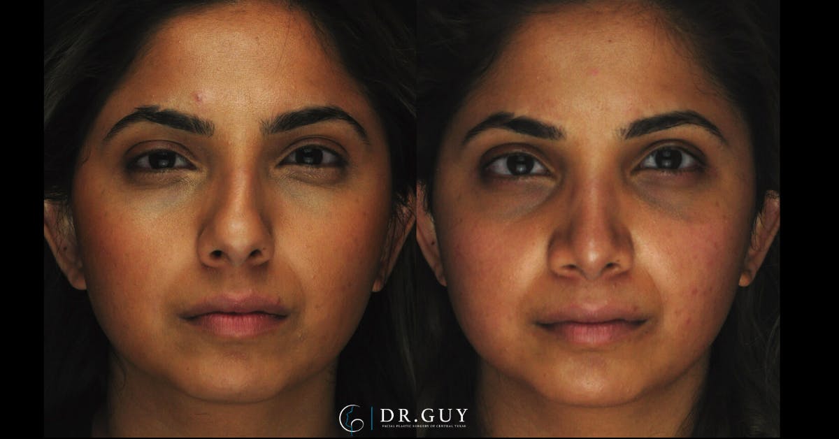 Surgical Rhinoplasty Before & After Gallery - Patient 348654 - Image 2