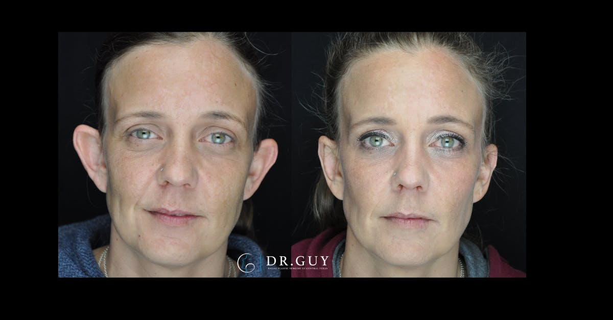 Otoplasty Before & After Gallery - Patient 260191 - Image 3