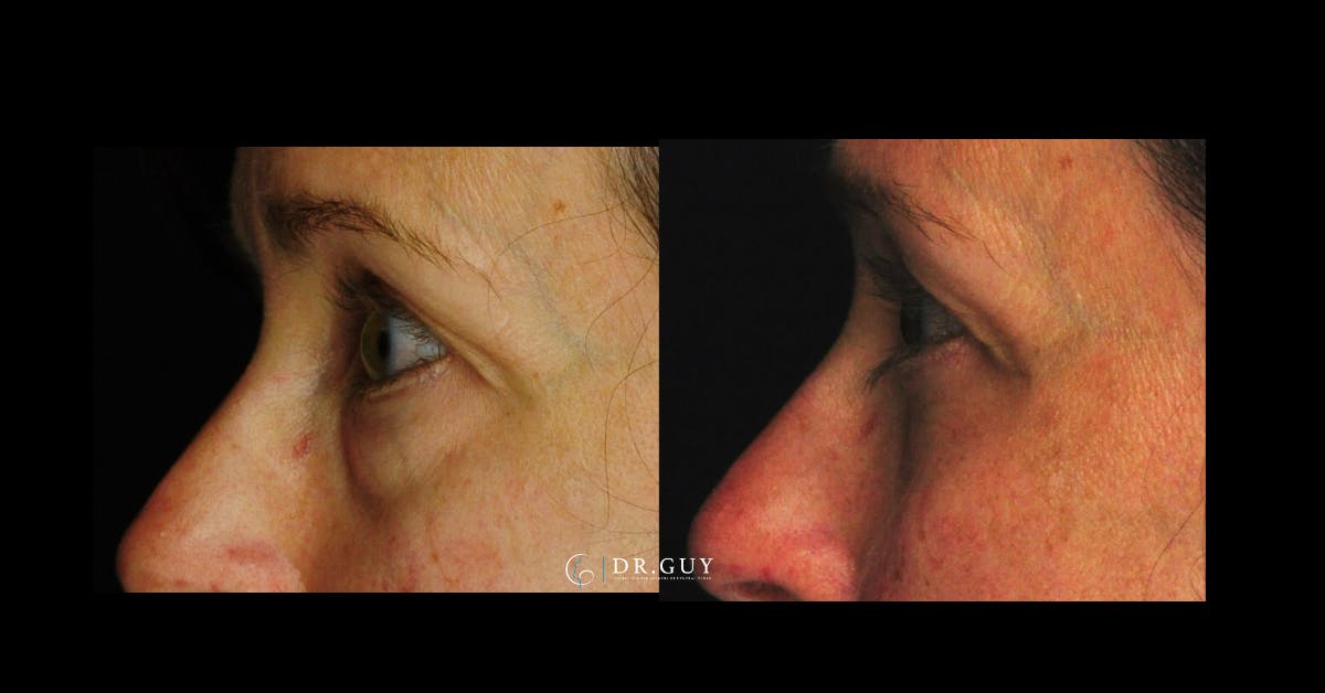 Lower Blepharoplasty Before & After Gallery - Patient 201537 - Image 4