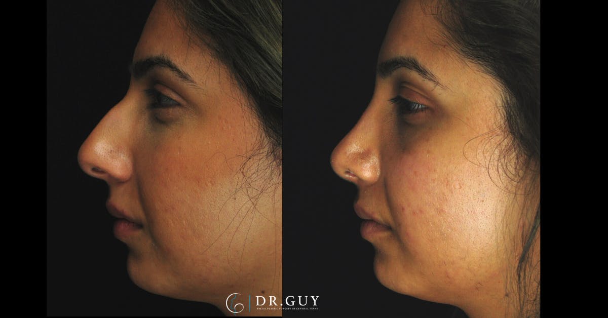 Surgical Rhinoplasty Before & After Gallery - Patient 348654 - Image 3