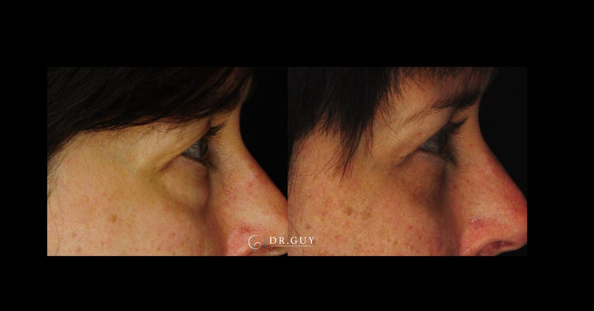 Lower Blepharoplasty Before & After Gallery - Patient 201537 - Image 5