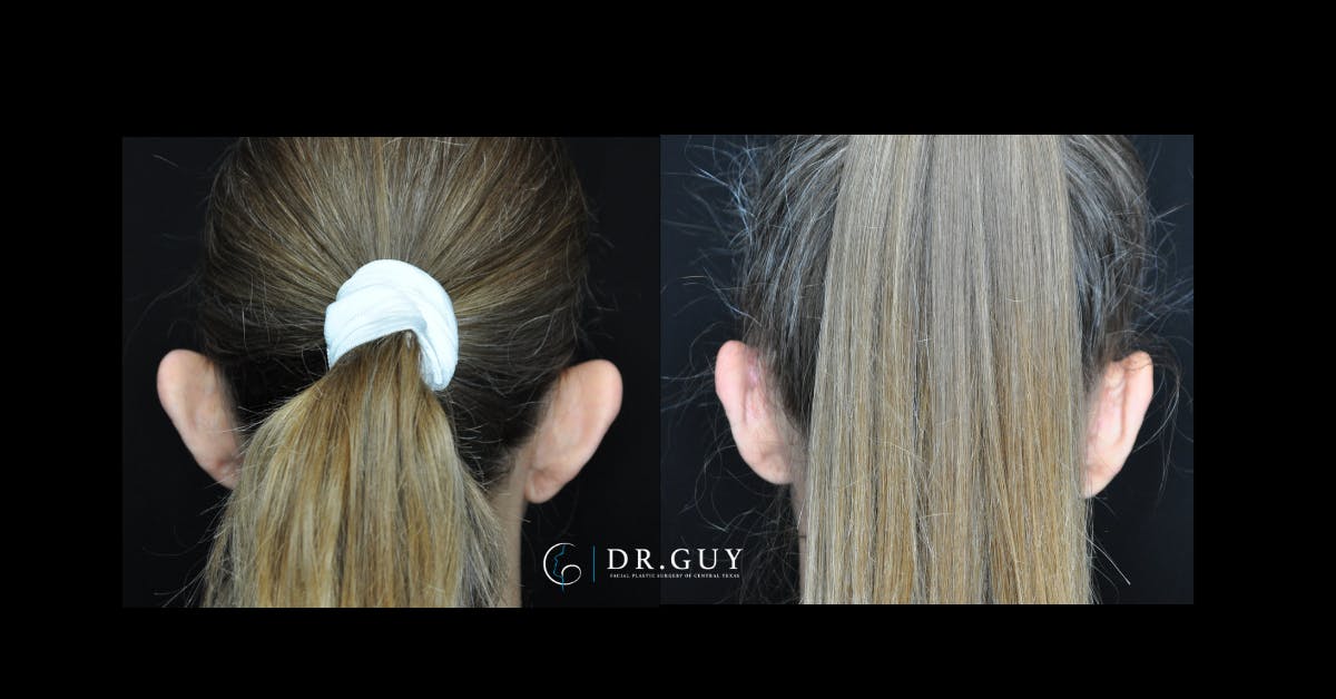 Otoplasty Before & After Gallery - Patient 260191 - Image 4