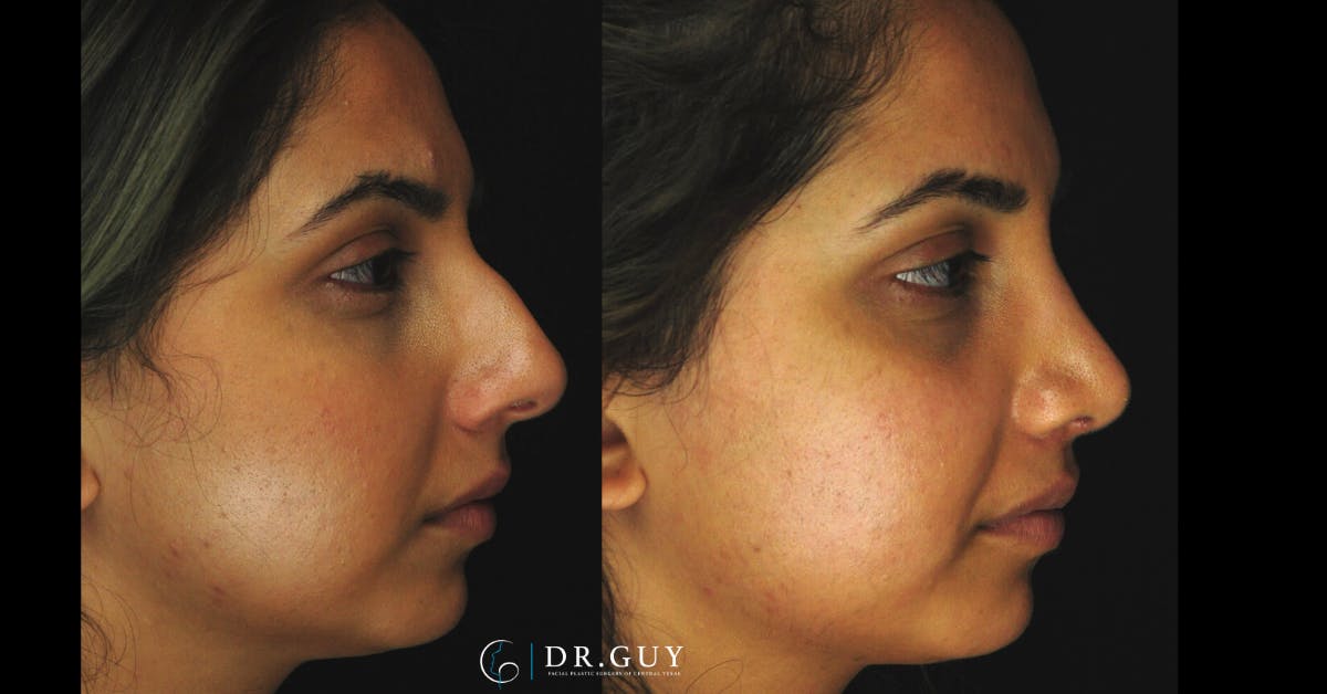 Surgical Rhinoplasty Before & After Gallery - Patient 348654 - Image 4