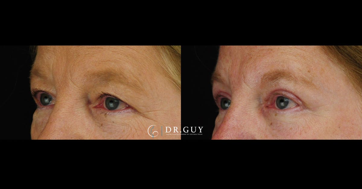 Upper Blepharoplasty Before & After Gallery - Patient 384978 - Image 1