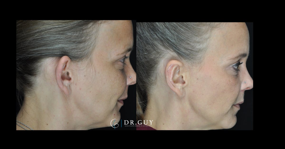 Otoplasty Before & After Gallery - Patient 260191 - Image 5