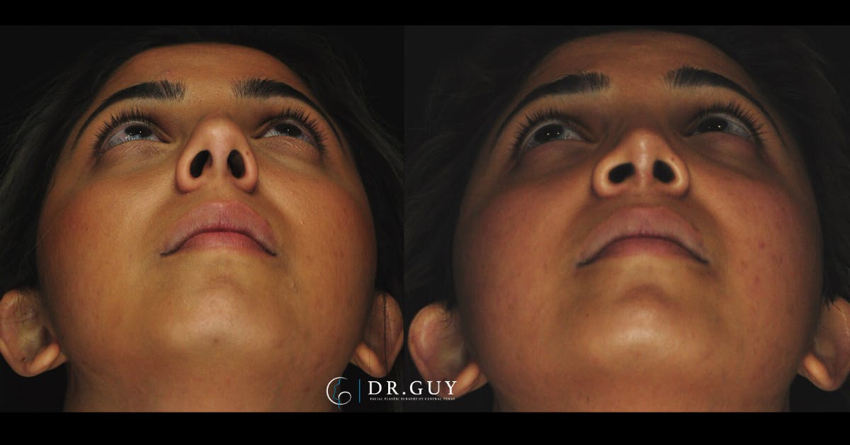 Surgical Rhinoplasty Before & After Gallery - Patient 348654 - Image 5