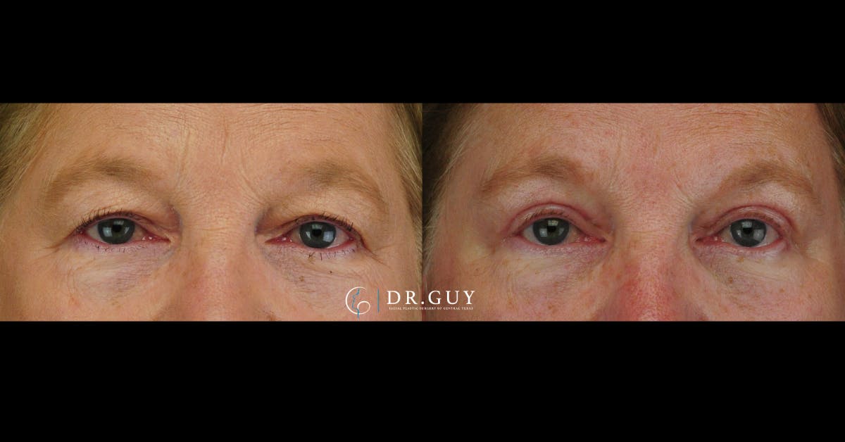 Upper Blepharoplasty Before & After Gallery - Patient 384978 - Image 2