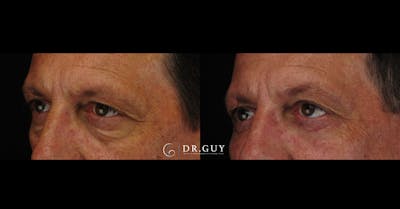 Lower Blepharoplasty Before & After Gallery - Patient 145843 - Image 1