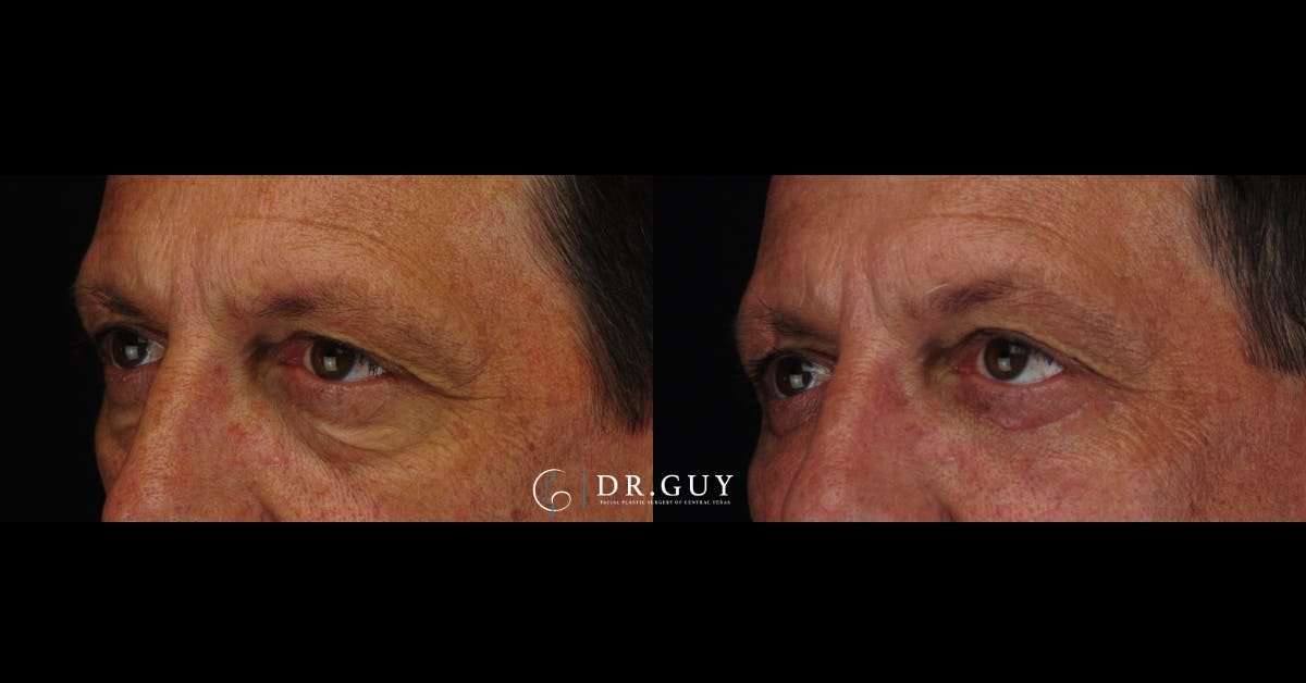 Lower Blepharoplasty Before & After Gallery - Patient 145843 - Image 1