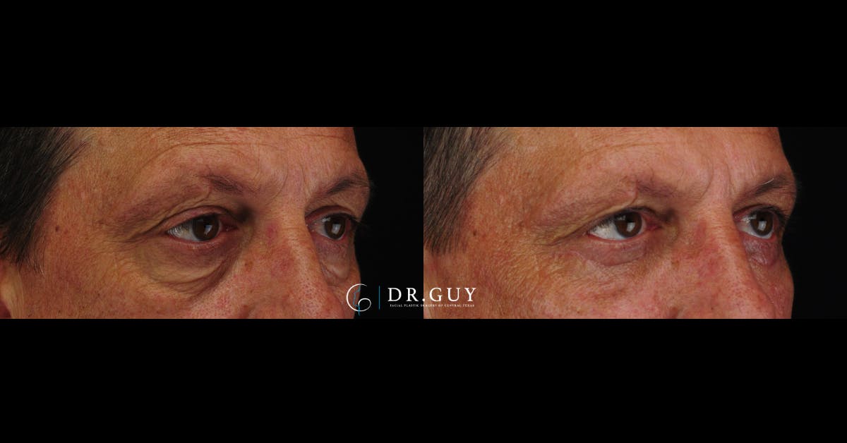 Lower Blepharoplasty Before & After Gallery - Patient 145843 - Image 2