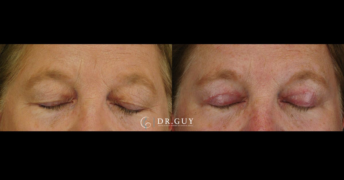 Upper Blepharoplasty Before & After Gallery - Patient 384978 - Image 3