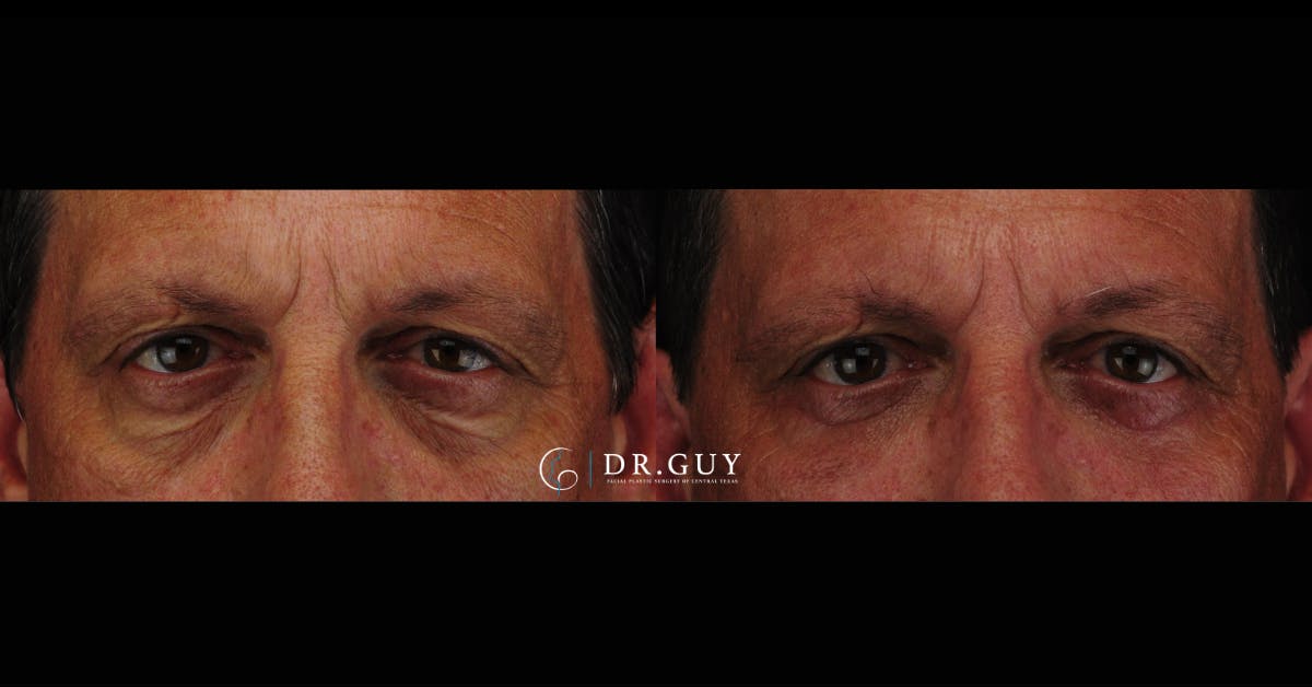 Lower Blepharoplasty Before & After Gallery - Patient 145843 - Image 3