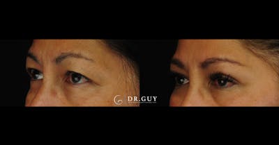 Upper Blepharoplasty Before & After Gallery - Patient 333437 - Image 1