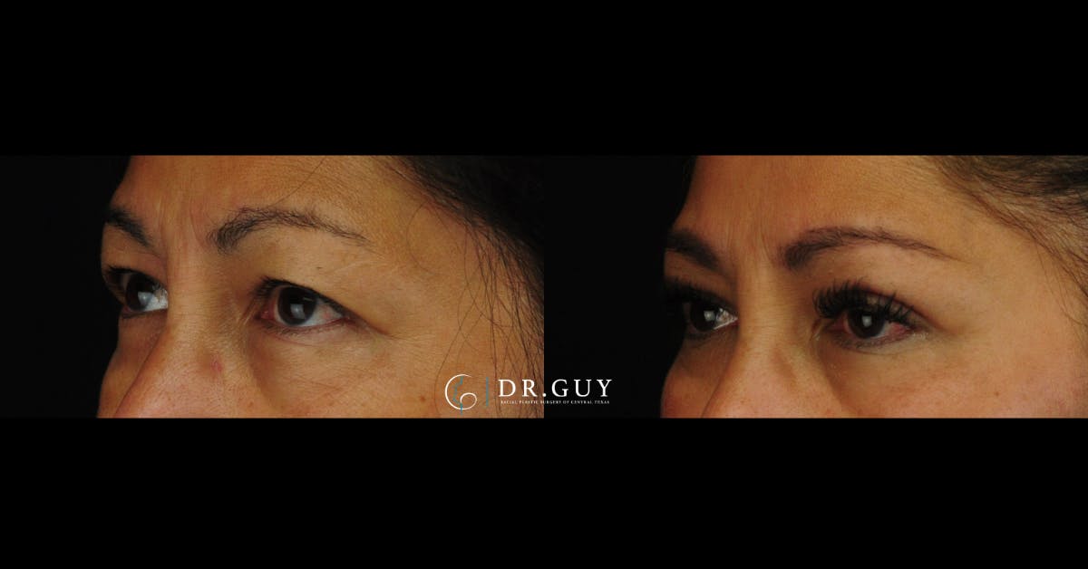 Upper Blepharoplasty Before & After Gallery - Patient 333437 - Image 1