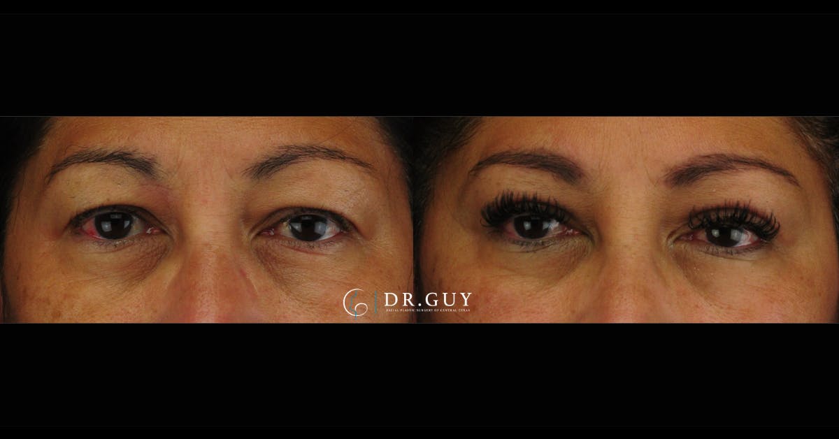 Upper Blepharoplasty Before & After Gallery - Patient 333437 - Image 2