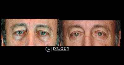 Lower Blepharoplasty Before & After Gallery - Patient 146911 - Image 1