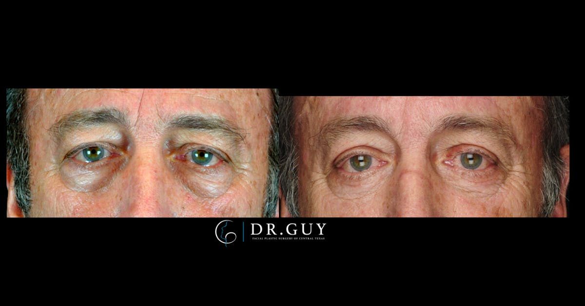 Lower Blepharoplasty Before & After Gallery - Patient 146911 - Image 1
