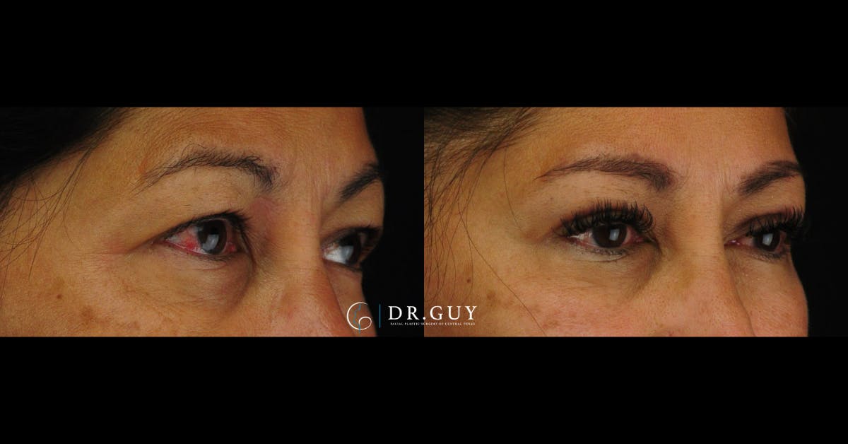 Upper Blepharoplasty Before & After Gallery - Patient 333437 - Image 3