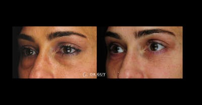 Lower Blepharoplasty Before & After Gallery - Patient 239272 - Image 1