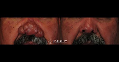 Rhinophyma Before & After Gallery - Patient 260552 - Image 1