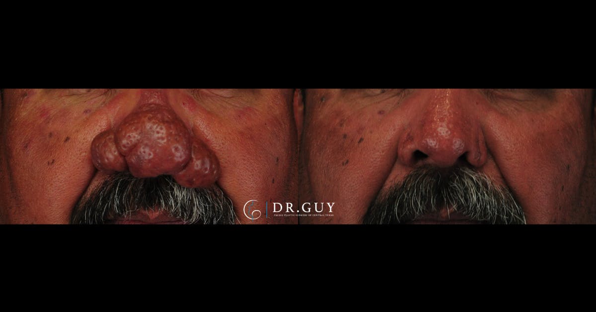 Rhinophyma Before & After Gallery - Patient 260552 - Image 1