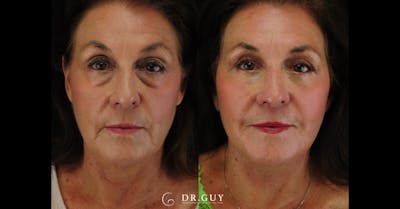 Upper Blepharoplasty Before & After Gallery - Patient 162804 - Image 1