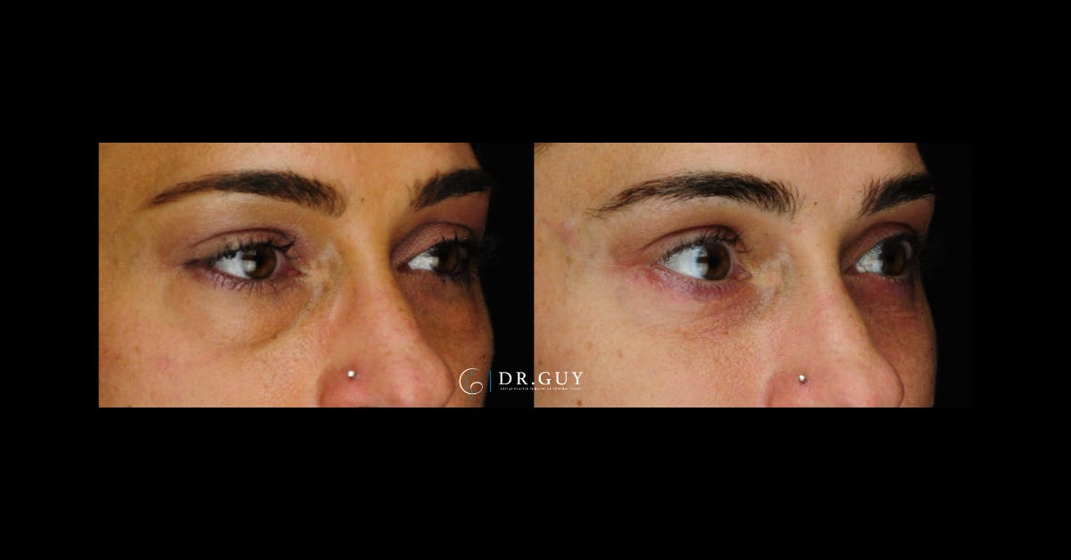 Lower Blepharoplasty Before & After Gallery - Patient 239272 - Image 2
