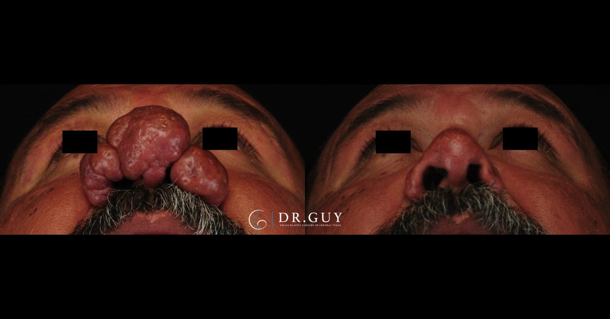 Rhinophyma Before & After Gallery - Patient 260552 - Image 2