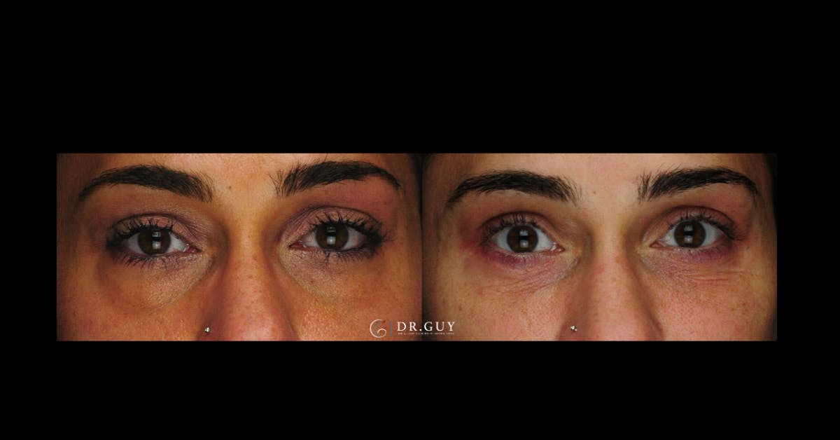 Lower Blepharoplasty Before & After Gallery - Patient 239272 - Image 3