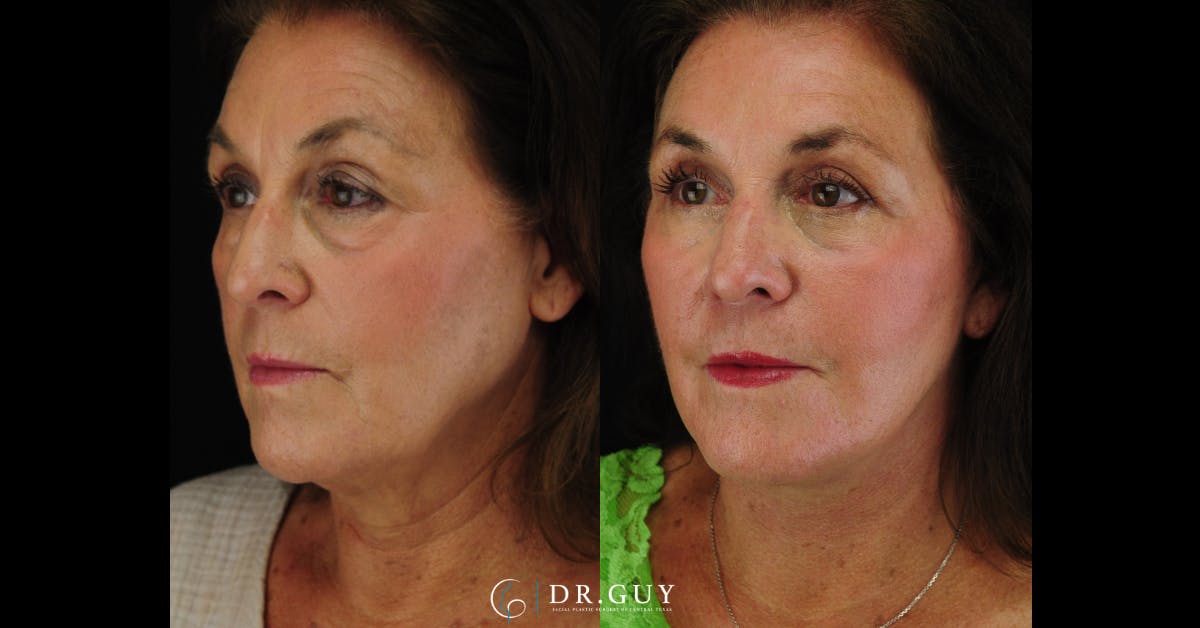 Upper Blepharoplasty Before & After Gallery - Patient 162804 - Image 2