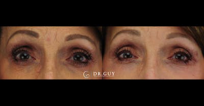 Chemical Peels Before & After Gallery - Patient 363008 - Image 1