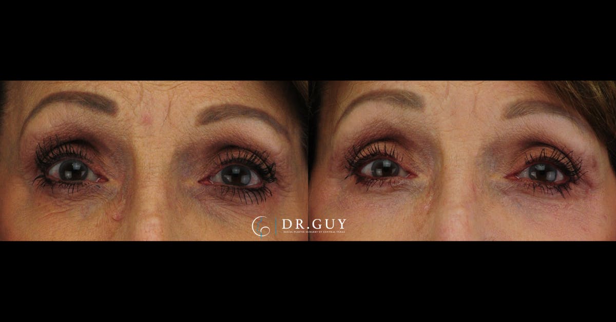 Chemical Peels Before & After Gallery - Patient 363008 - Image 1