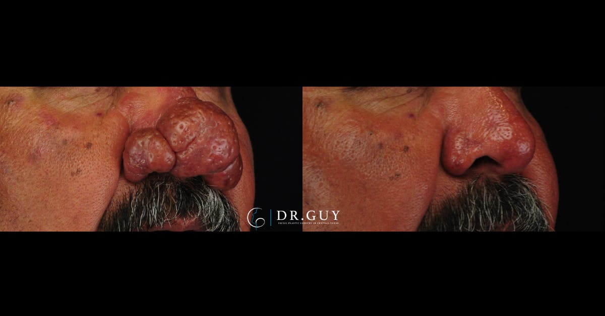 Rhinophyma Before & After Gallery - Patient 260552 - Image 3