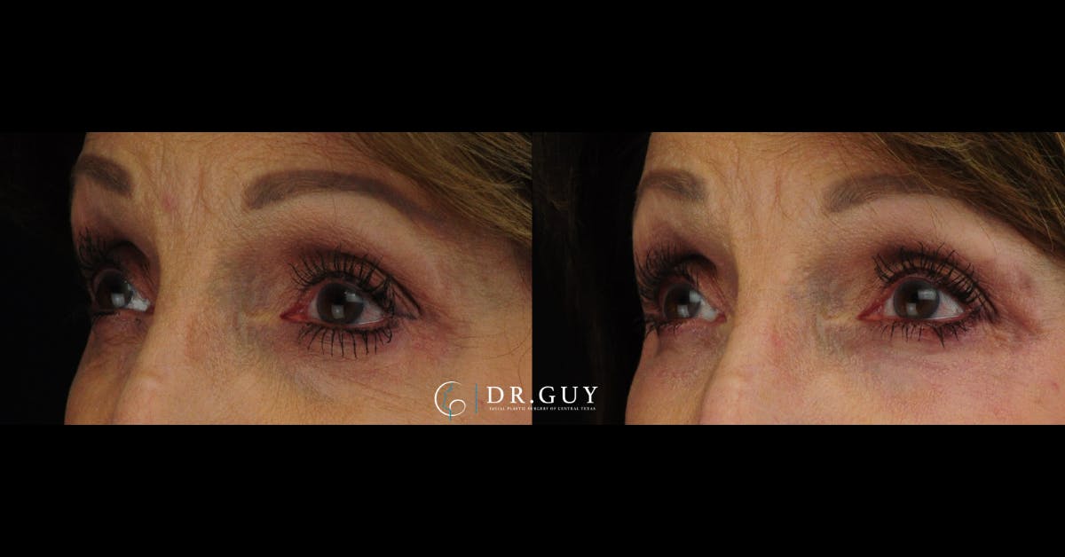 Chemical Peels Before & After Gallery - Patient 363008 - Image 2