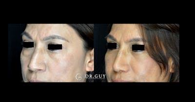 Lower Blepharoplasty Before & After Gallery - Patient 761890 - Image 1