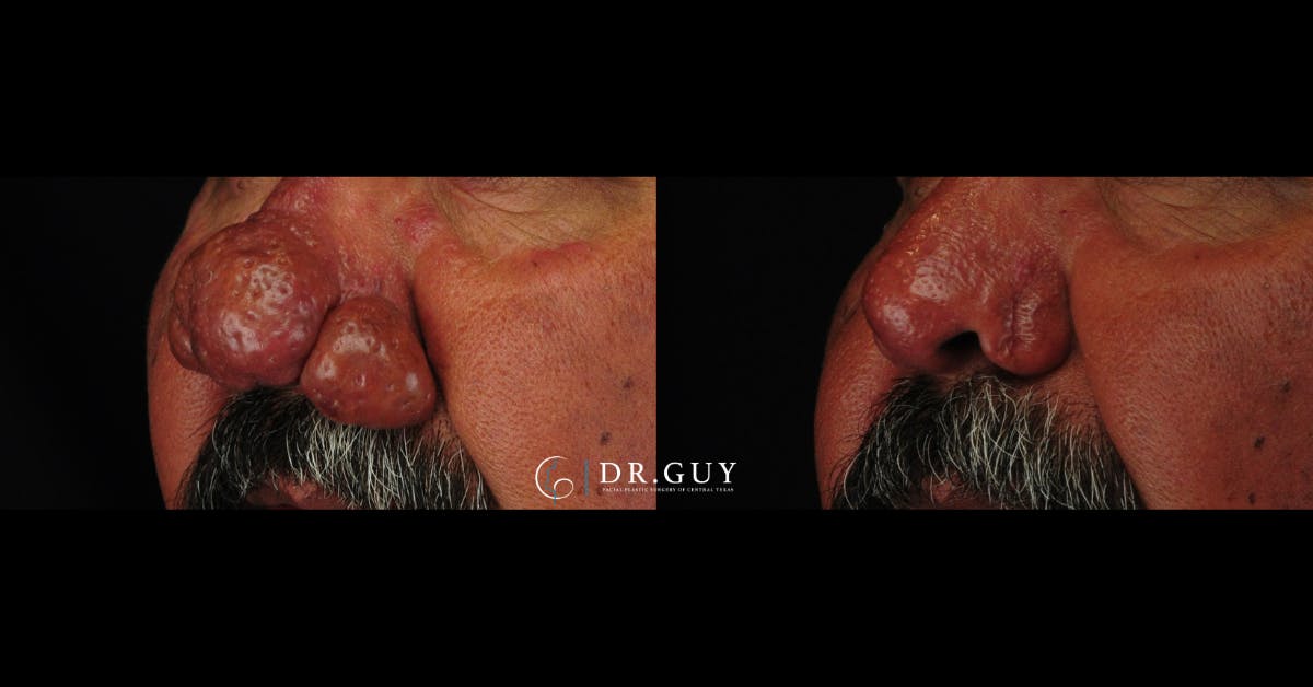 Rhinophyma Before & After Gallery - Patient 260552 - Image 4