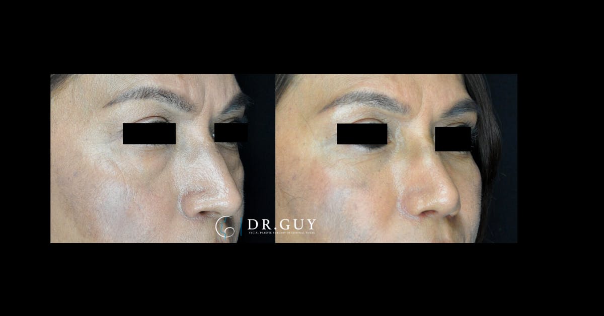 Lower Blepharoplasty Before & After Gallery - Patient 761890 - Image 2