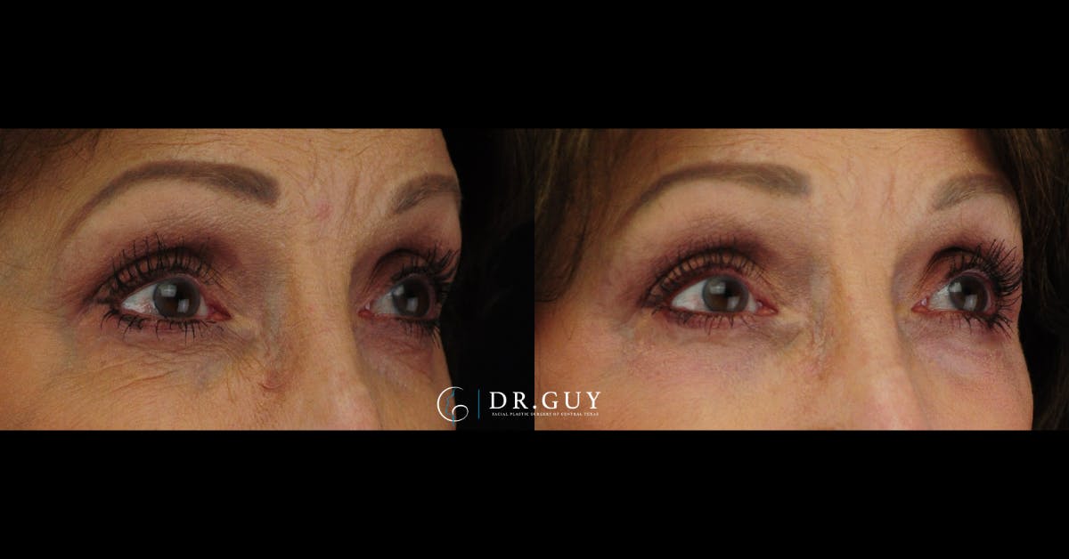 Chemical Peels Before & After Gallery - Patient 363008 - Image 3