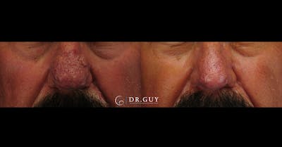 Rhinophyma Before & After Gallery - Patient 275582 - Image 1