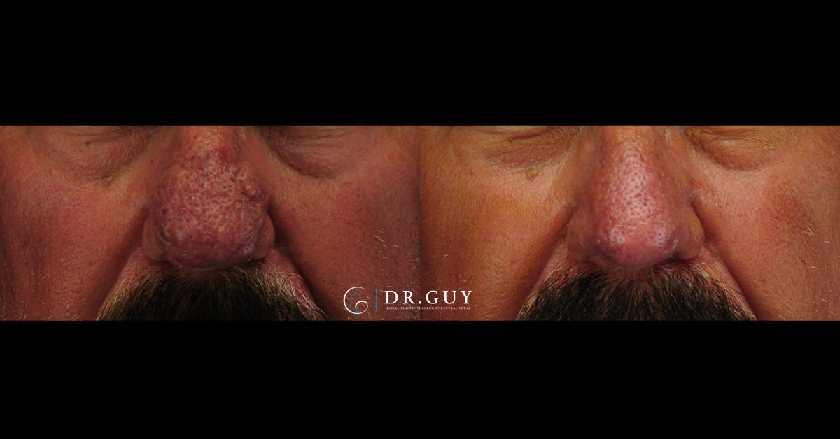 Rhinophyma Before & After Gallery - Patient 275582 - Image 1