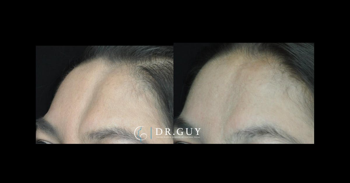 Fat Grafting Before & After Gallery - Patient 396504 - Image 1