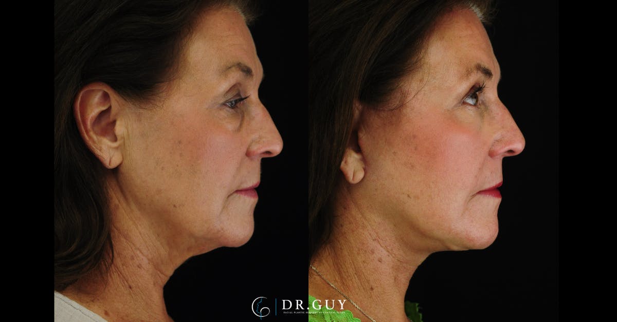 Upper Blepharoplasty Before & After Gallery - Patient 162804 - Image 5