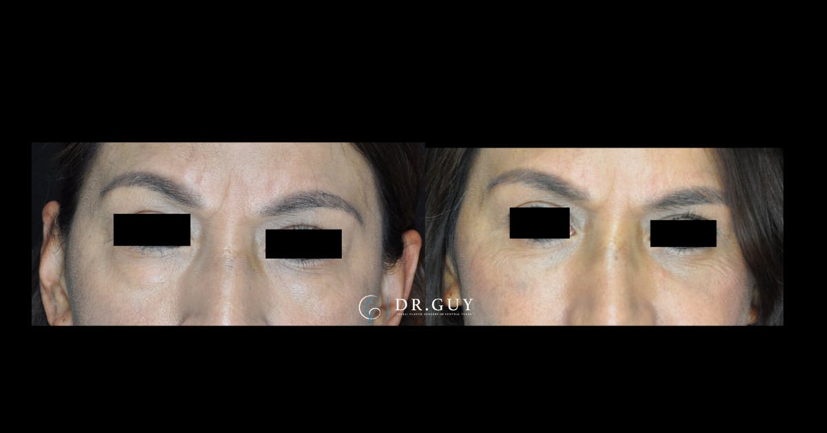 Lower Blepharoplasty Before & After Gallery - Patient 761890 - Image 3