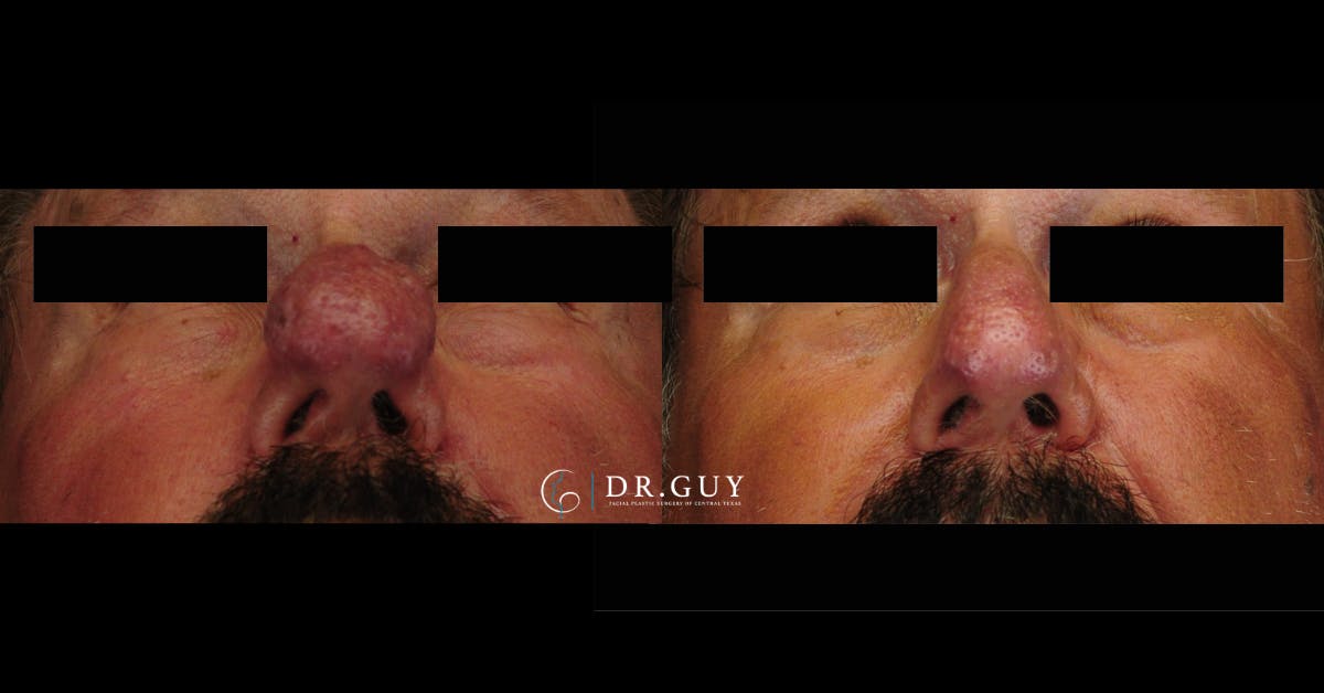 Rhinophyma Before & After Gallery - Patient 275582 - Image 2