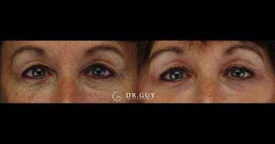 Chemical Peels Before & After Gallery - Patient 245775 - Image 1