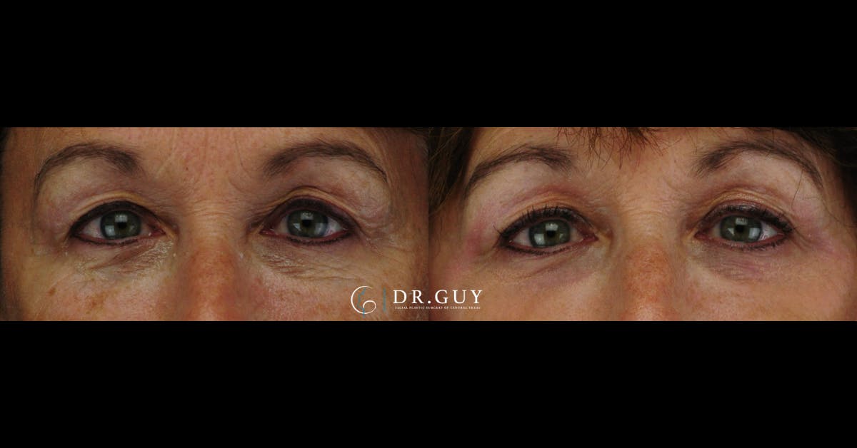 Chemical Peels Before & After Gallery - Patient 245775 - Image 1