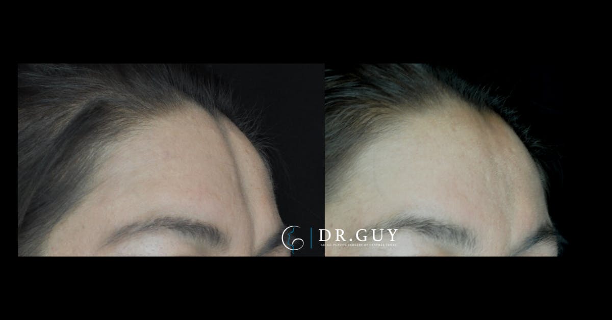 Fat Grafting Before & After Gallery - Patient 396504 - Image 2