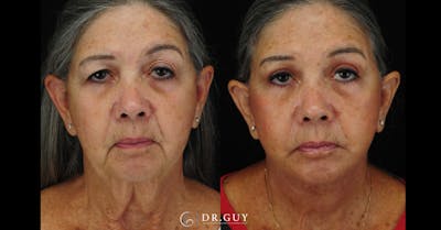 Upper Blepharoplasty Before & After Gallery - Patient 411047 - Image 1