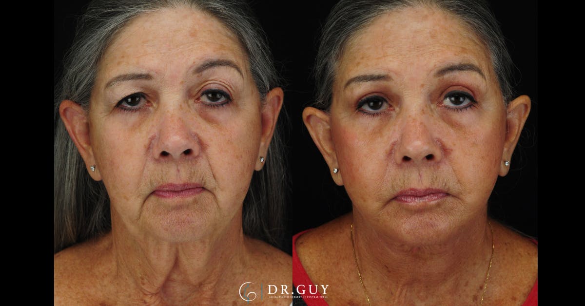 Upper Blepharoplasty Before & After Gallery - Patient 411047 - Image 1